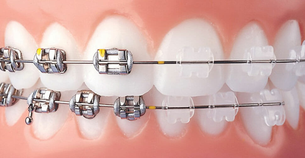 Aparelho Autoligado Damon VS. Aparelho Invisalign