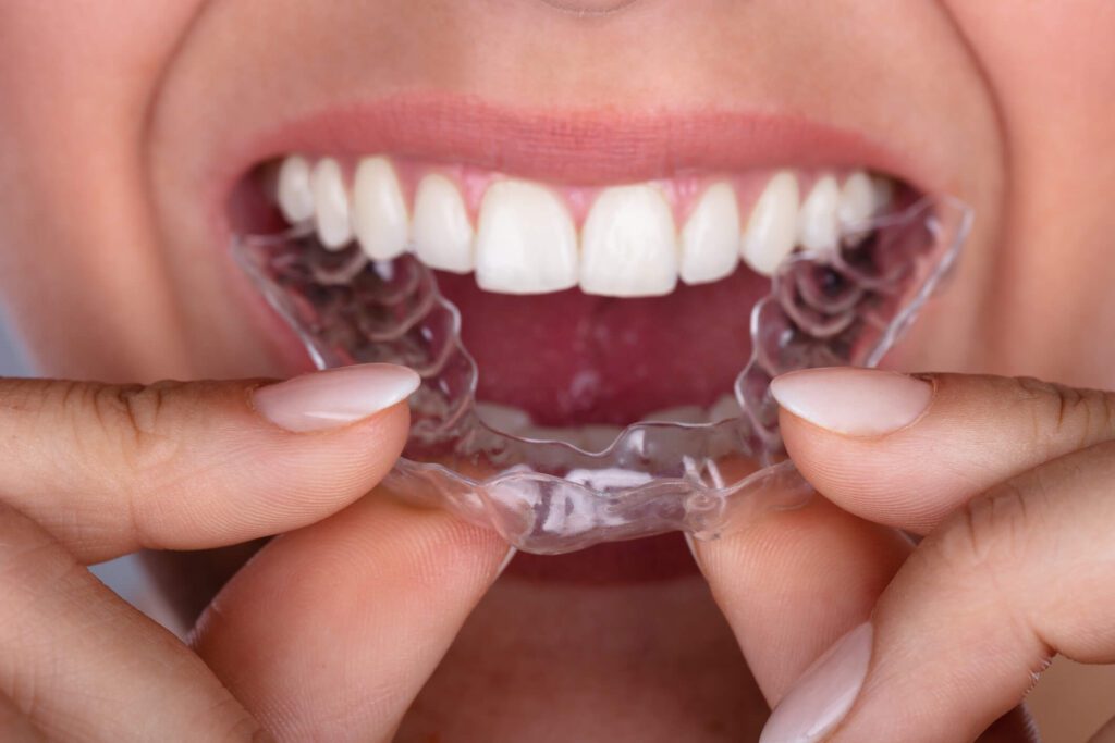 entenda-o-que-e-invisalign-e-quais-as-suas-vantagens