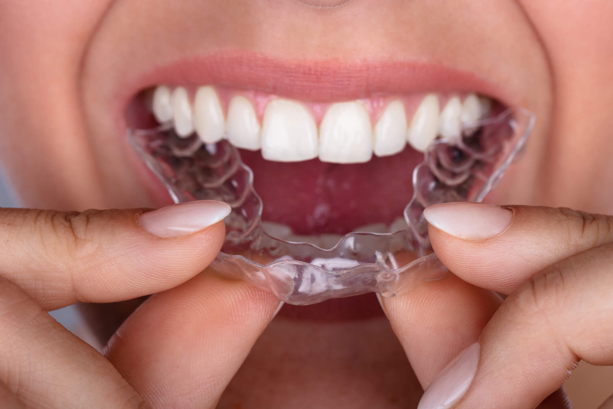 entenda-o-que-e-invisalign-e-quais-as-suas-vantagens